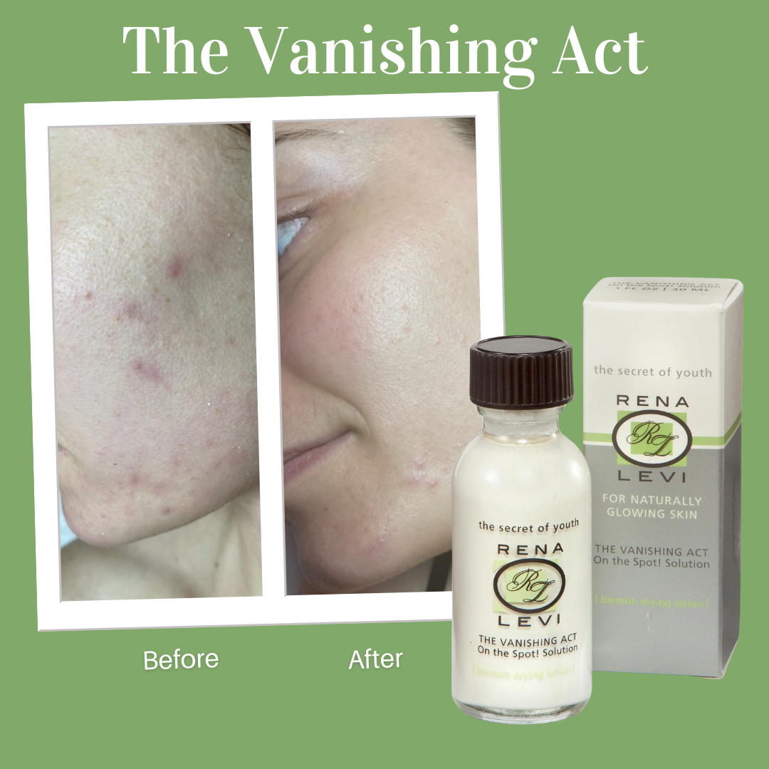 On the Spot! Acne Emergency Solution