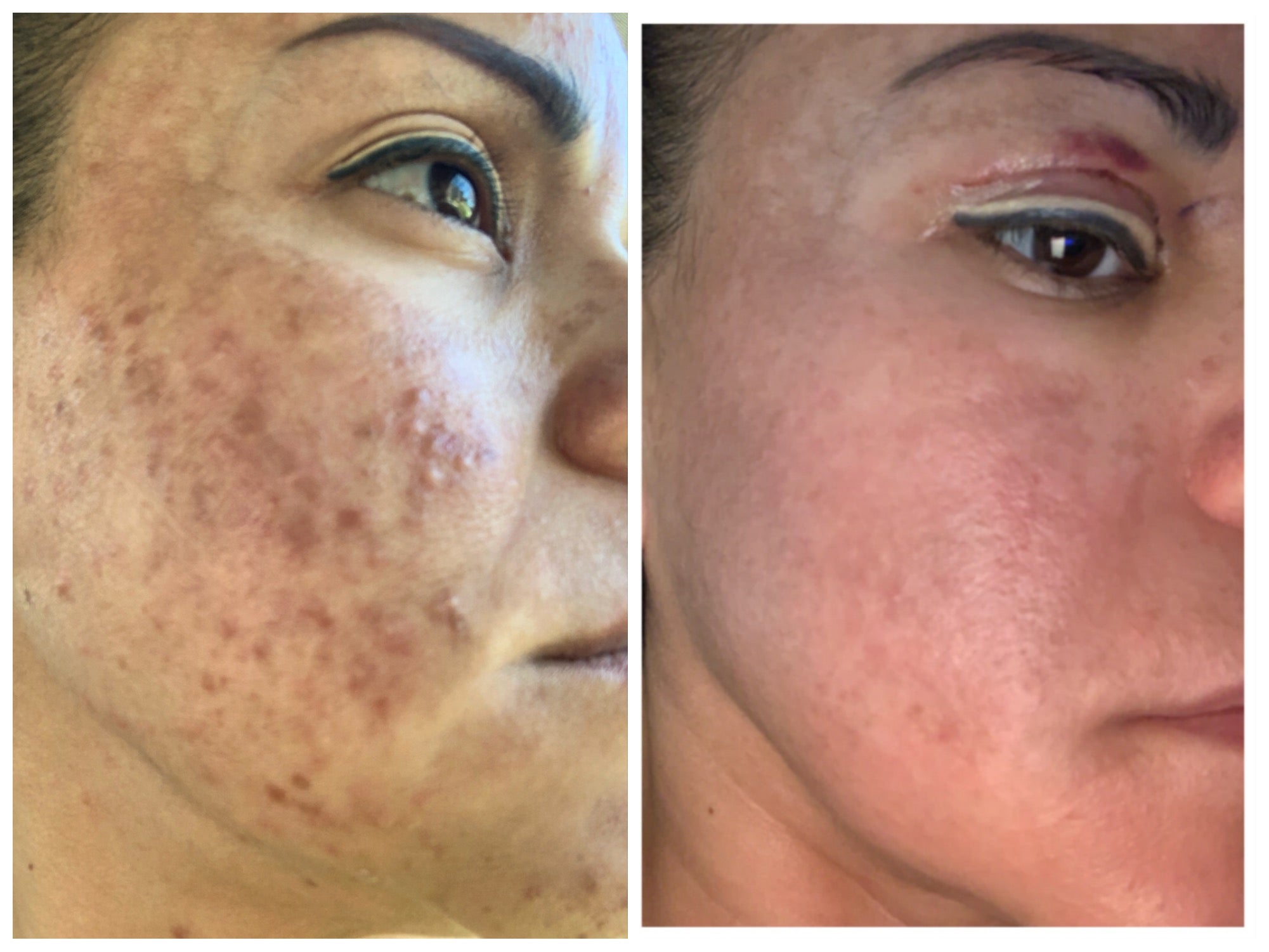 Acne Soap The Vanishing Act