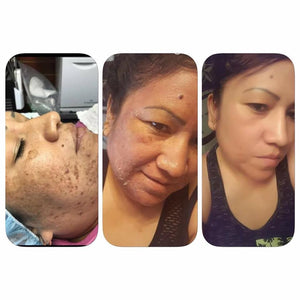 Rena Levi’s Deep Herbal Peel Kit   (PRO)