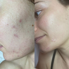 Load image into Gallery viewer, Rena Levi’s Deep Herbal Peel Kit   (PRO)