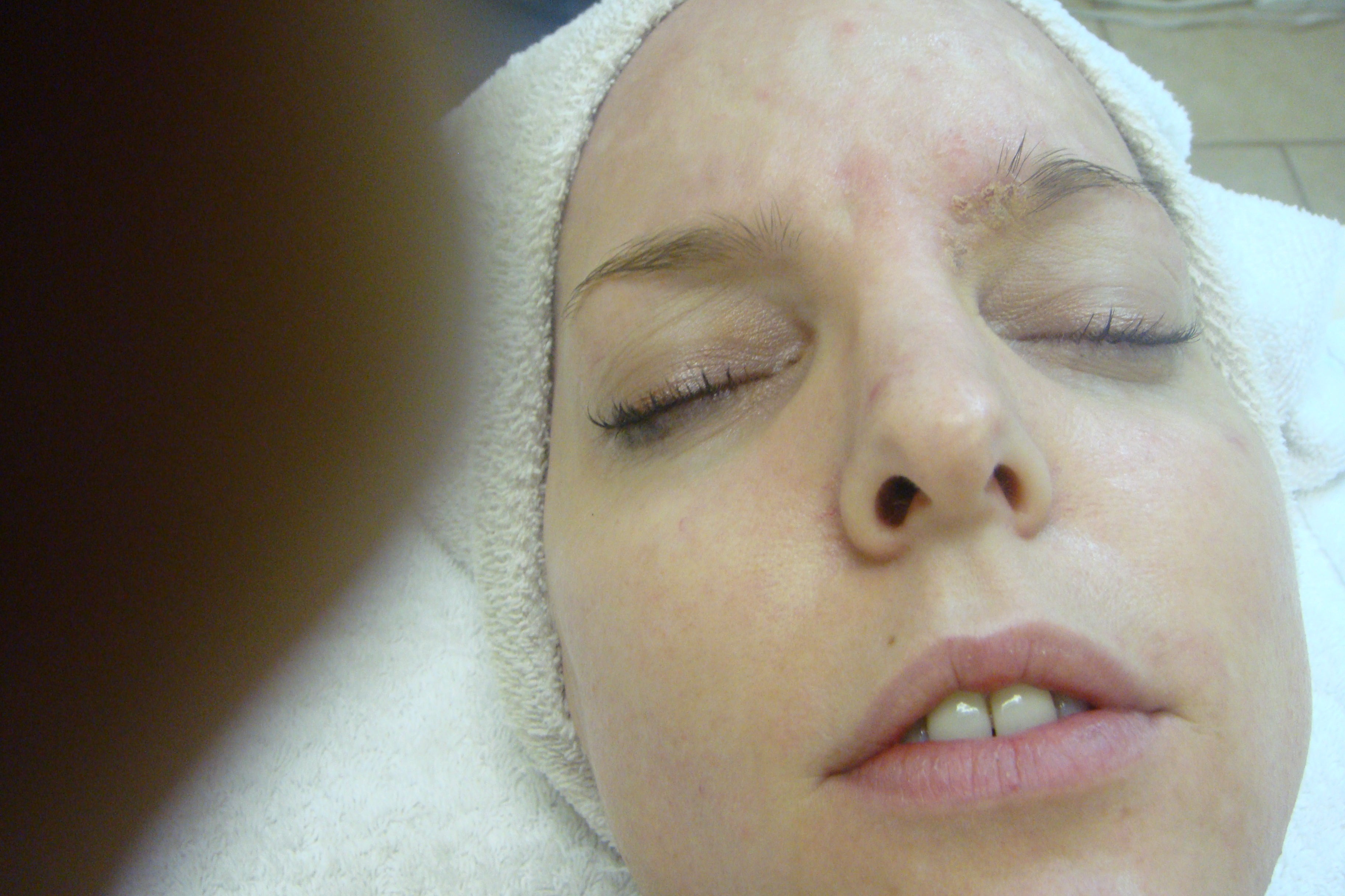 Acne Soap The Vanishing Act