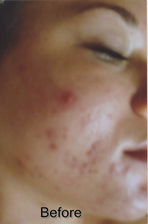 Acne Soap The Vanishing Act