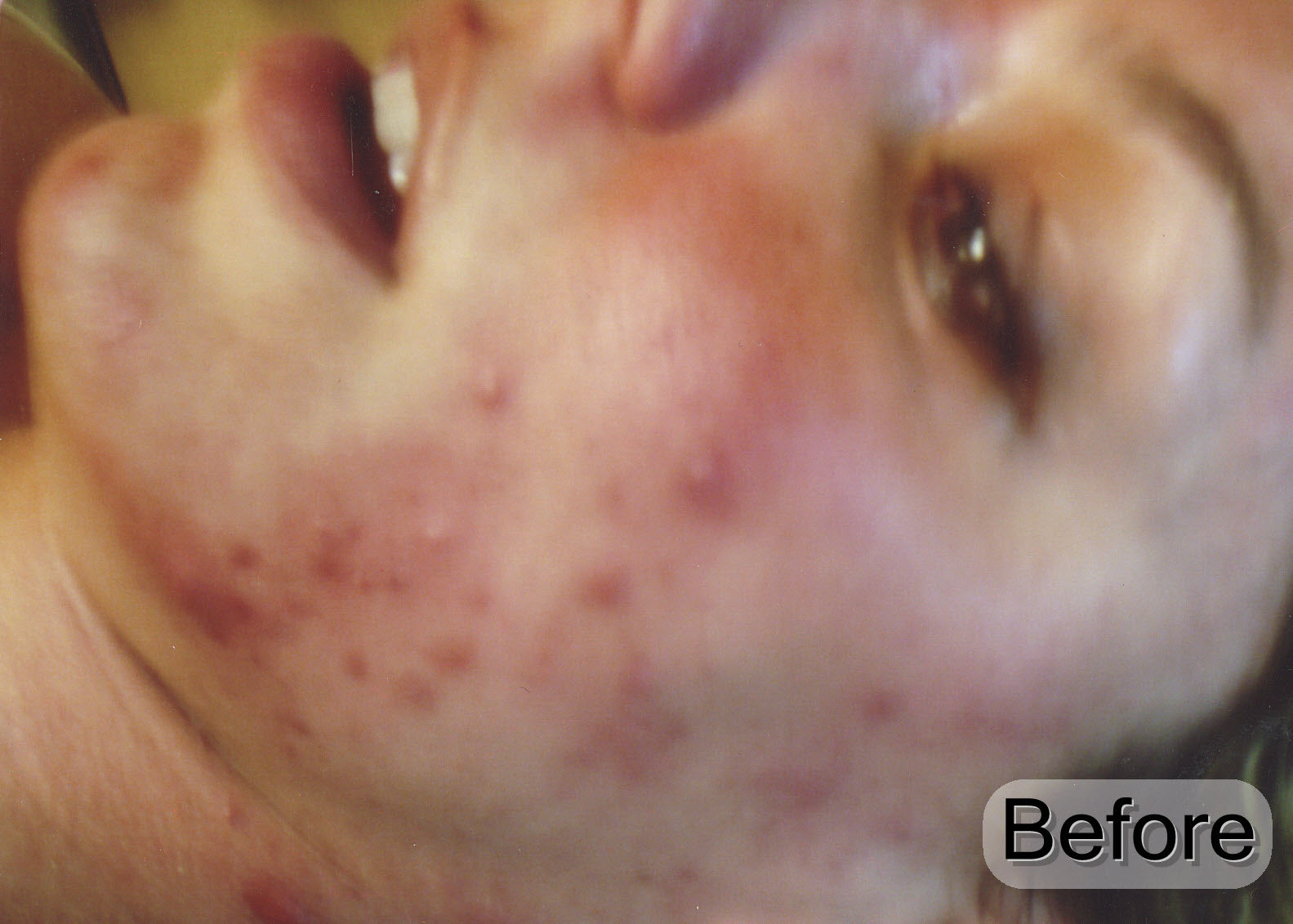 Acne Soap The Vanishing Act