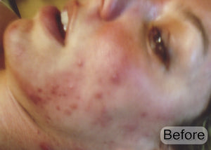 Rena Levi’s Deep Herbal Peel Kit   (PRO)