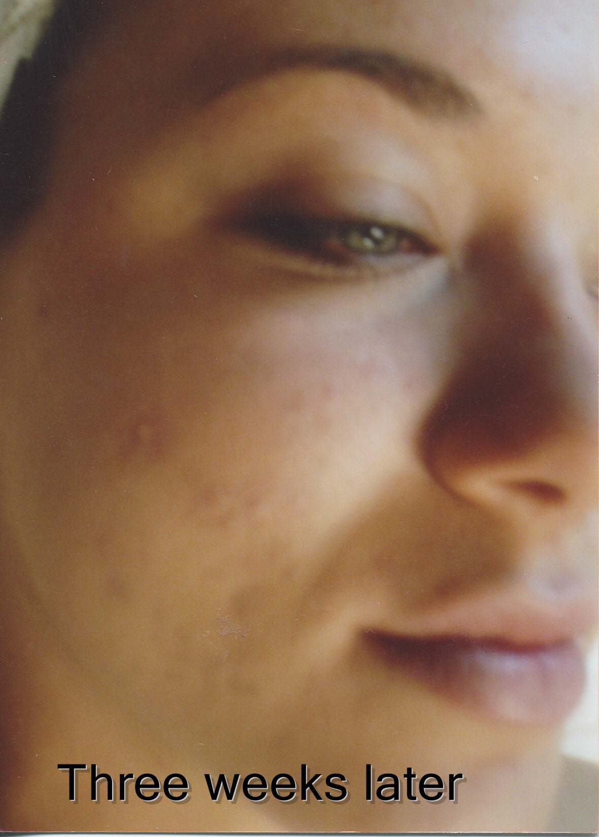 Acne Soap The Vanishing Act