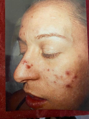 Acne Soap The Vanishing Act