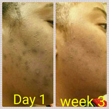 Load image into Gallery viewer, The Amazing Scrub Acne Treatment 2oz